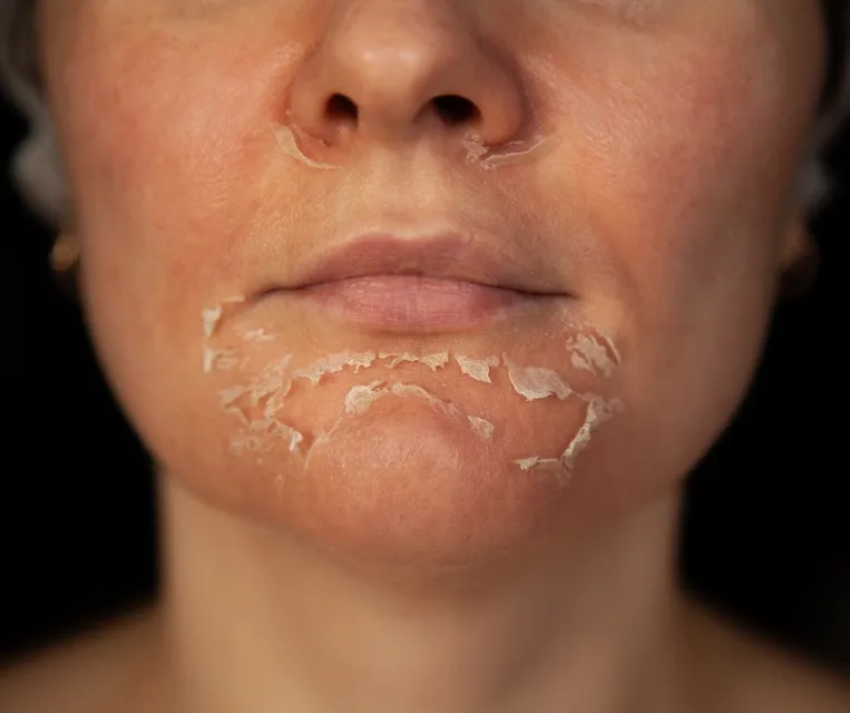 a woman after getting a Chemical Peel