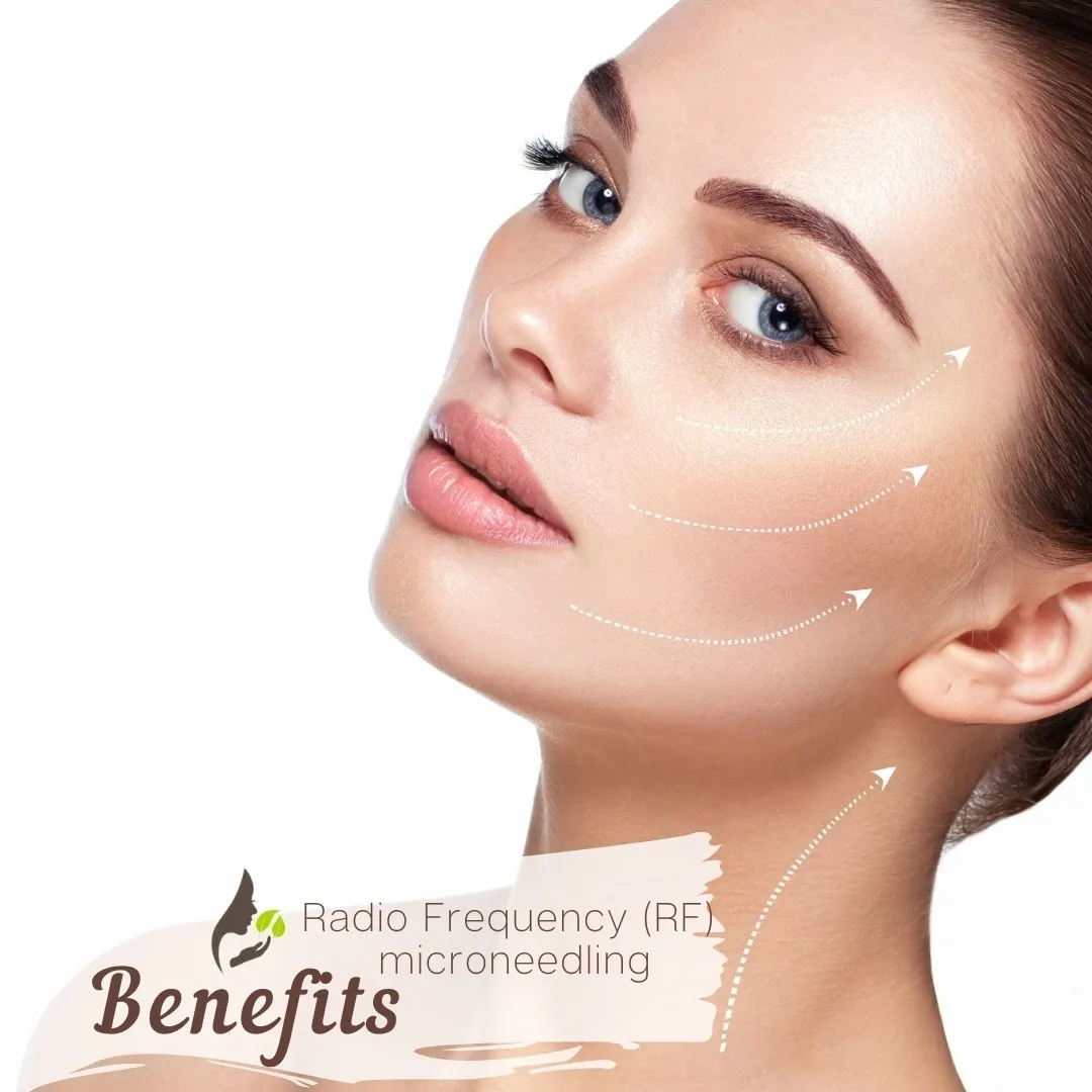 RF Microneedling: The Ultimate Anti-Aging Solution Nu Age Aesthetics