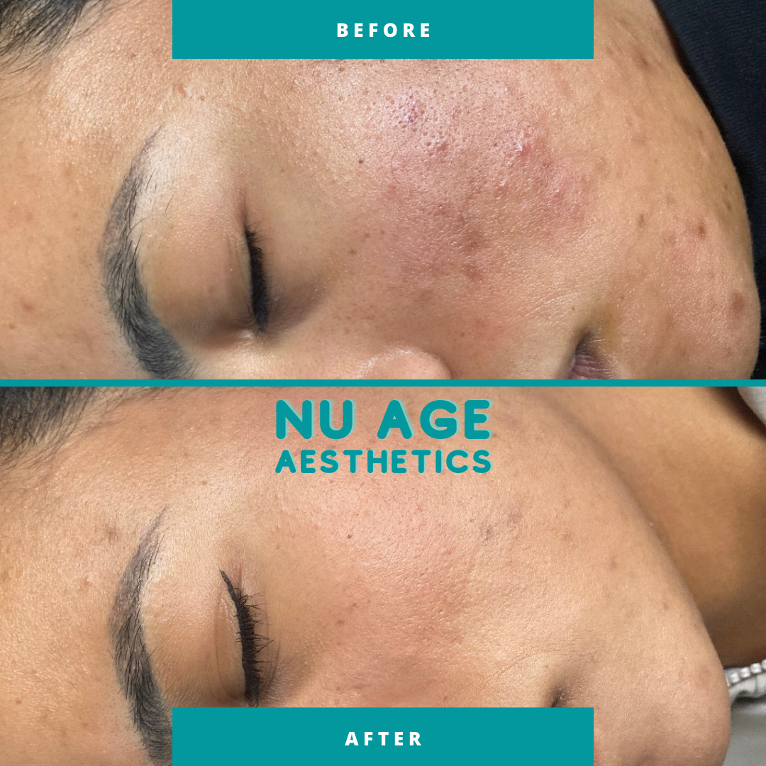 Transform Your Skin with Medical Grade Chemical Peels - Safe, Effective Treatment for Fine Lines, Acne, and Hyperpigmentation