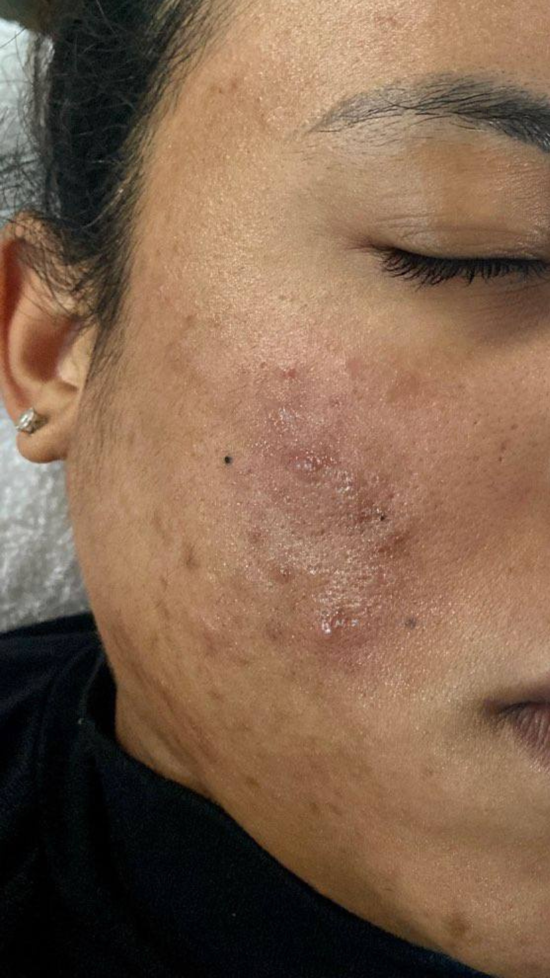 woman with acne