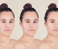 picture of a woman showing the before and after for acne treatment