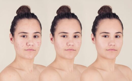 picture of a woman showing the before and after for acne treatment