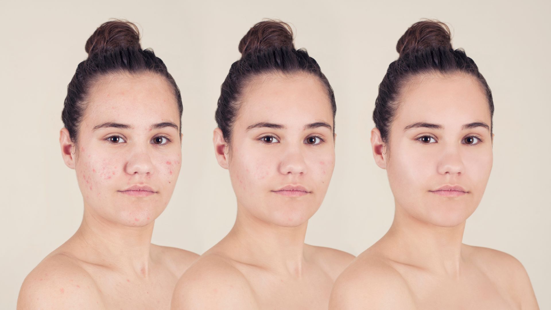 picture of a woman showing the before and after for acne treatment