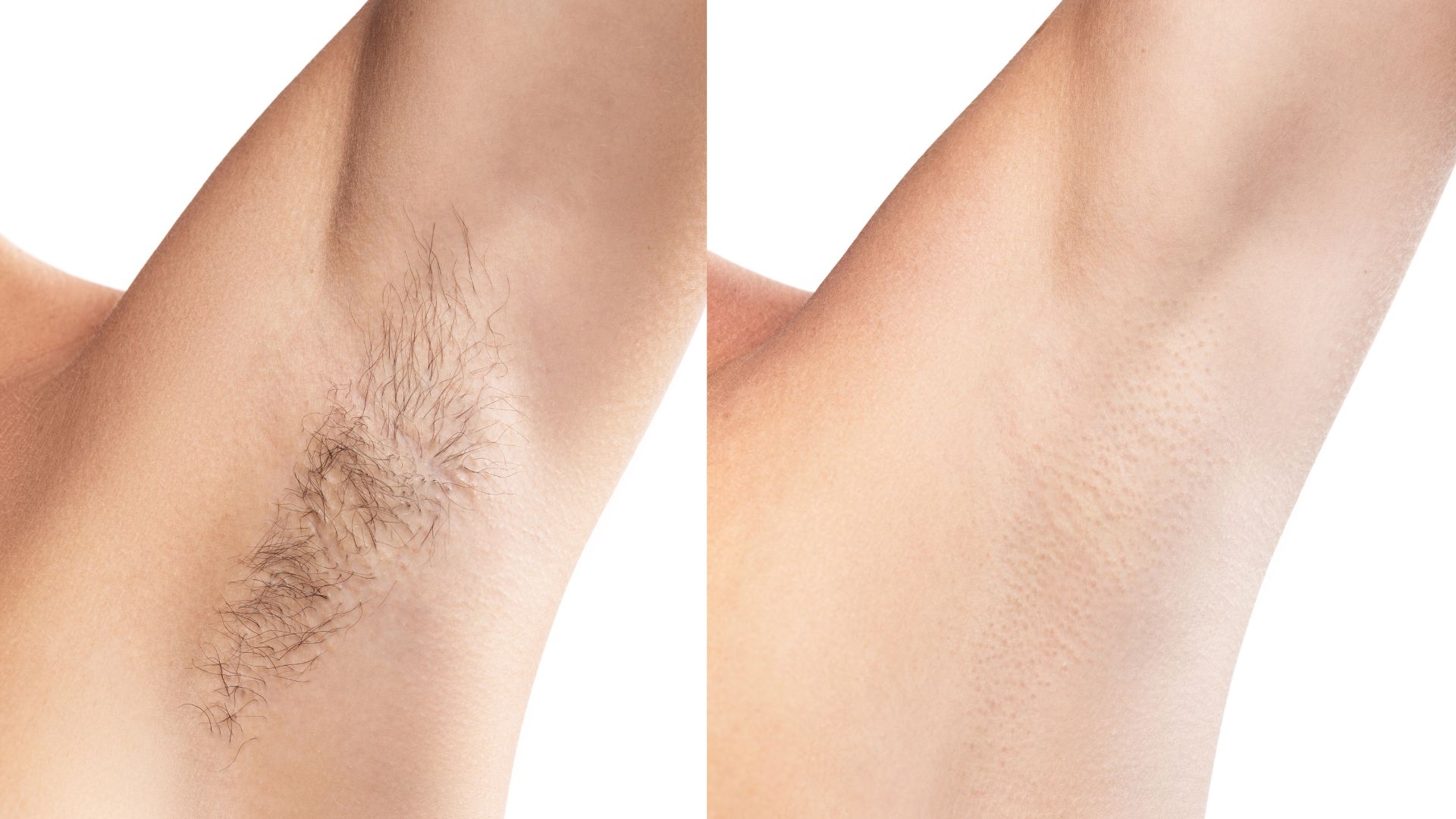 picture of woman before and after hair removal