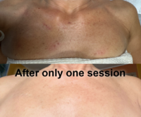 picture of a woman's chest after getting Pigmentation Correction service