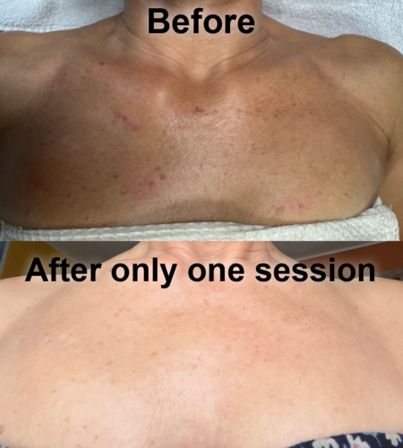 picture of a woman's chest after getting Pigmentation Correction service