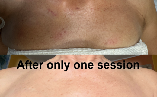 picture of a woman's chest after getting Pigmentation Correction service