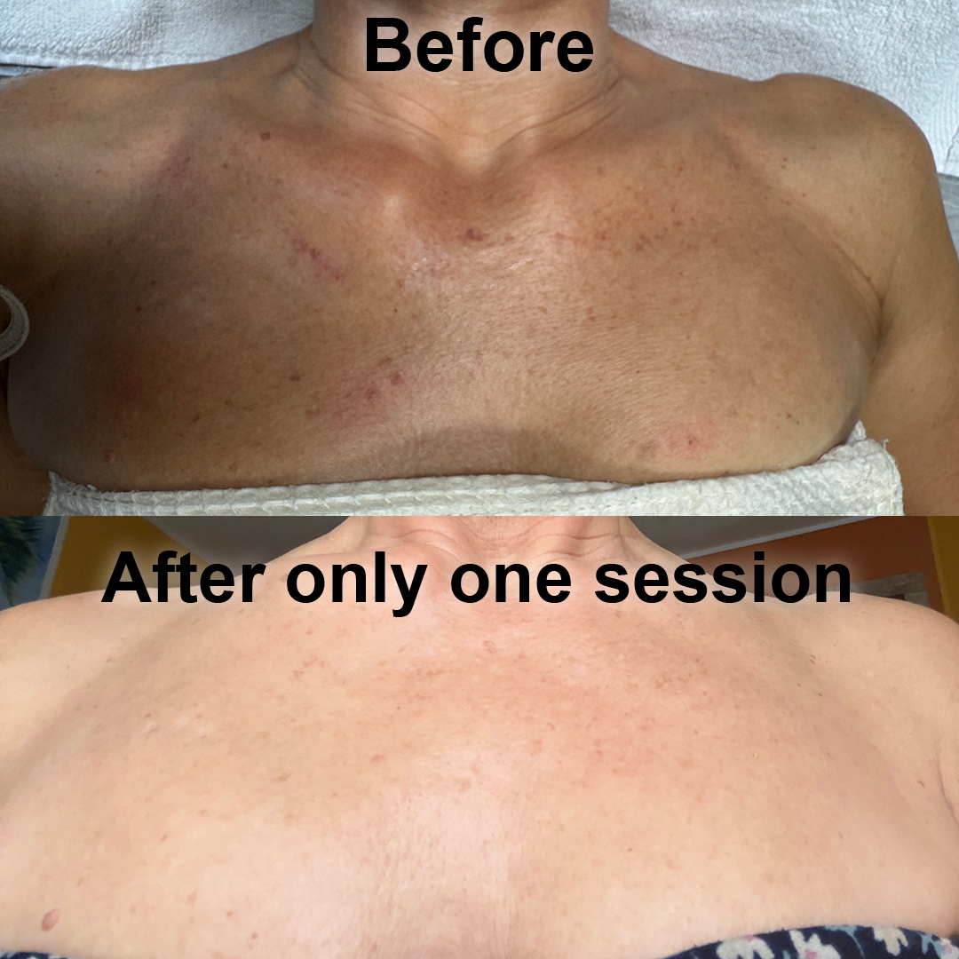 picture of a woman's chest after getting Pigmentation Correction service